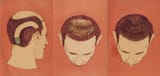 hair-flap-diagram-01