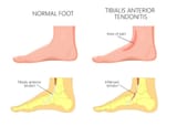 Tibialis-Anterior-Tendonitis-1024x732