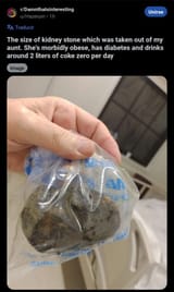 kidney stone