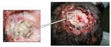 Scalp-human-myiasis-showing-massive-Chrysomya-bezziana-larvae-infestation-original