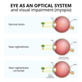 vision-impairment-myopia