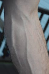forearm-veins-1[1]