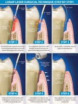 lanap-laser-surgical