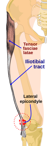 275px-Iliotibial_band_syndrome-en.svg