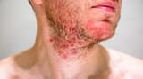 Skin-Rashes-scaled