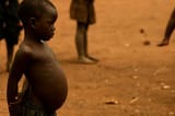 malnourished_people