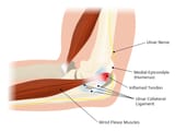 Medial+Elbow+Pain