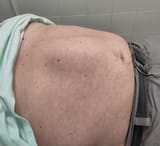 Diastasis_recti,_old_man