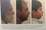 Progressive reduction in the forward dentofacial growth