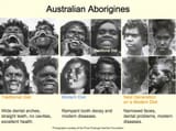 abbo teeth