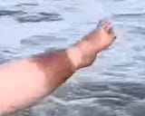 venous stasis