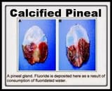 pineal-gland-fluoride-calcified