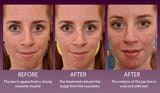 Masseter-muscle-reduction-with-Botox-to-showing-change-in-muscle