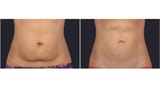 Non-surgical-fat-removal-from-stomach-Blog-600x350-1