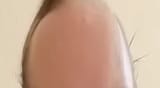 Gatis forehead