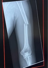 broken humerus