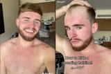 hide-a-receding-hairline
