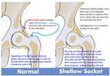 normal vs dysplasic hip