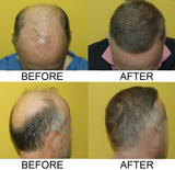 Zarev 9000 grafts