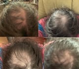 balding