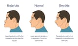 underbite-what-is-an-underbite-17153779
