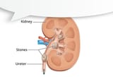 AKIdneyStoneTypedThis