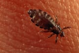 head-louse-from-above_3x2