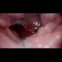cervix pov_thumb.jpg