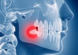 impacted_wisdom_teeth-1459876383