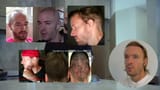 goatis hair transplant