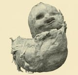 Lithopedion_1898