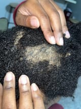 scabs-stuck-on-scalp-v0-wvjoenitwece1