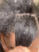 dry-flaky-itchy-scalp-v0-s2nc3i1n5rqe1