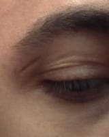 scar