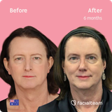 ffs-surgery-before-and-after-forehead-rhinoplasty-jaw-and-chin-traquea-shave-feminization-jina-front-square