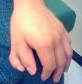 Polydactyly_(cropped)