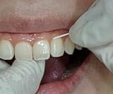 Screenshot-Floss-below-gum