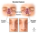 16924-deviated-septum