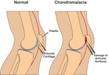 Chondromalacia-patella