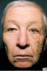Sun damage