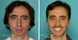 before-after-patient-16-v2