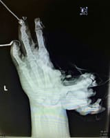 Xray