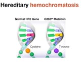 Hemochromatosis