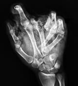 xray-fireworks-injury-radiology-clinical-original