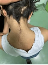 Back-of-the-neck-shows-a-low-hairline-and-hairy-back-of-the-neck-hirsutism