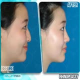As-Rhinoplasty-1