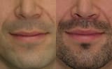 lip-lift-male-before-after-f-194
