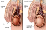 testicular-torsion