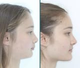 What an overbite looks like