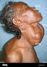 patient-has-a-multinodular-goitre-a-swelling-in-the-neck-just-below-CRP7E1